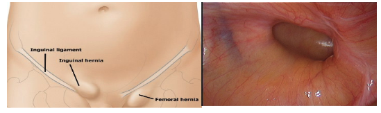 Inguinal hernia anatomical illustration