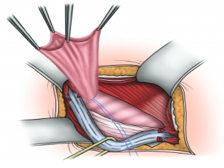 Your guide to understanding inguinal hernias