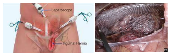 Inguinal hernia anatomical illustration
