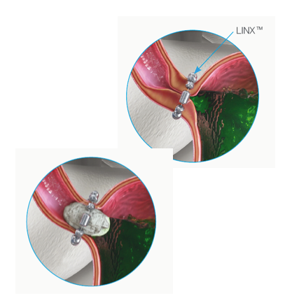 linx magnetico