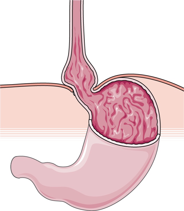Sliding hiatus hernia: the oesophago-gastric junction slides upward through the diaphragm