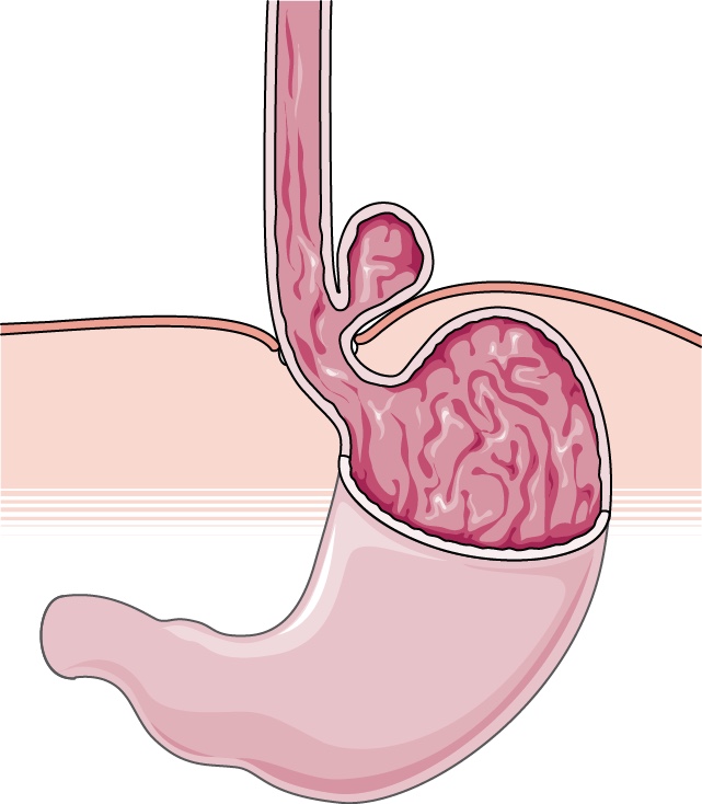 Paraesophageal hernia: the fundus of the stomach migrates into the chest alongside the oesophagus
